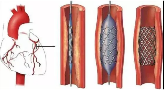 心臟支架高精密激光切割